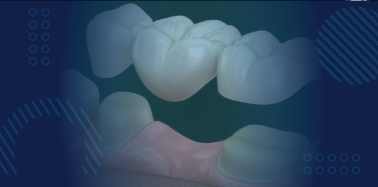 3 unit bridge (Porcelain fused to Metal Crown)